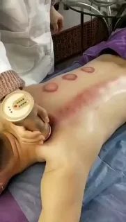 Баночный массаж спины